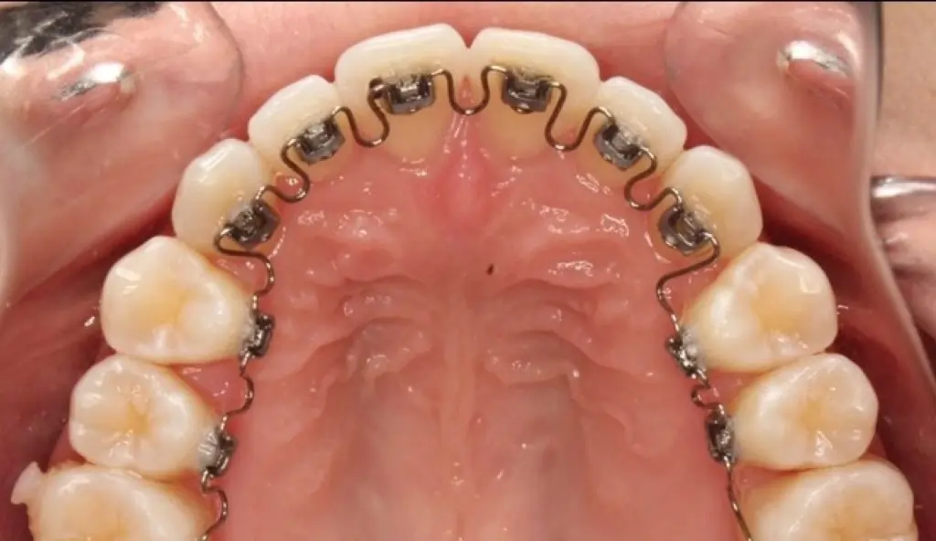  Hidden Braces (Inbrace)