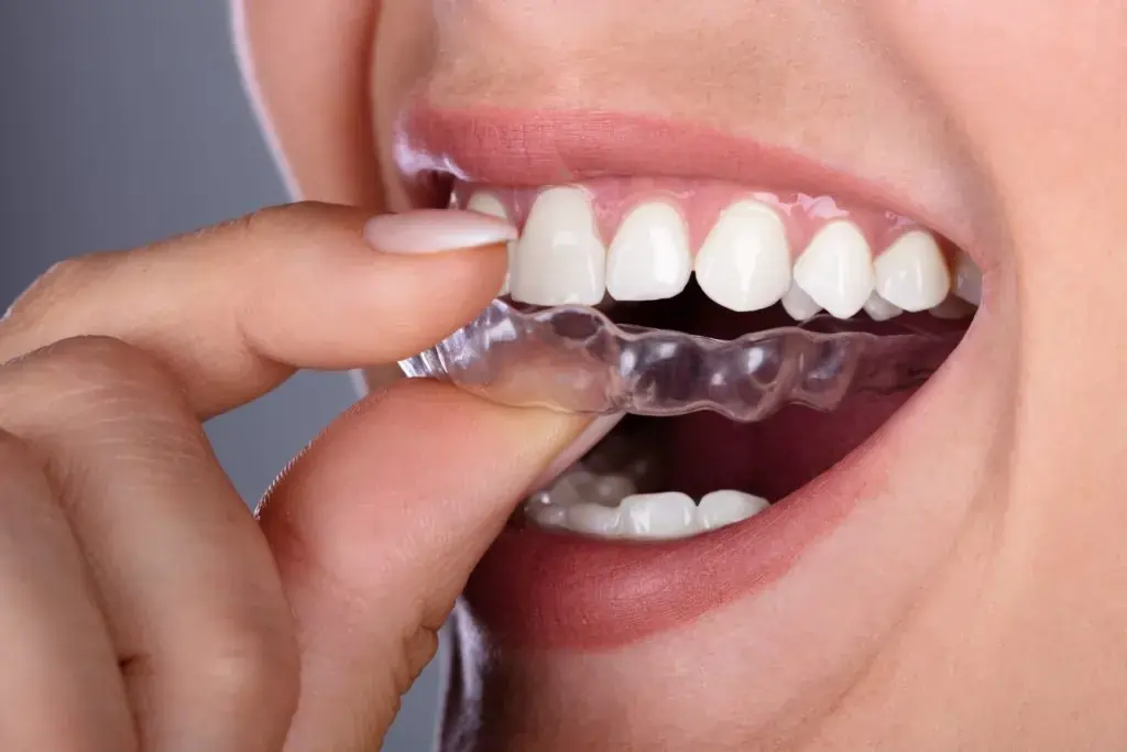 Invisalign & Angel Aligners